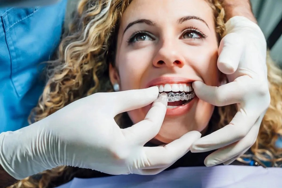 clear aligners